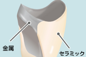 メタルボンド