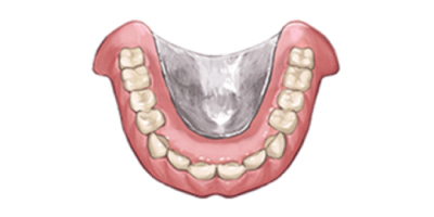 金属床義歯（チタン・コバルトクロム）