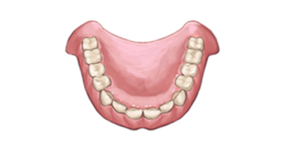 保険の入れ歯（プラスチック義歯）