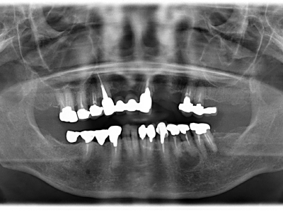 インプラント症例