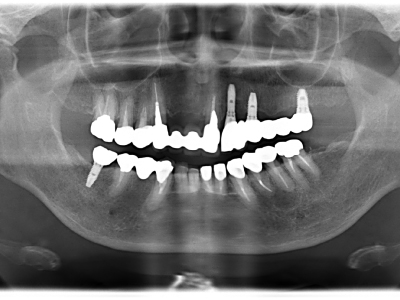 インプラント症例